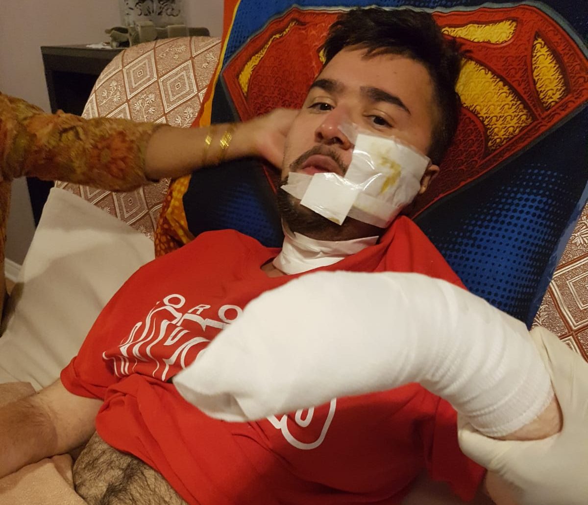 Man Left with Burns to Face and Arm After Samsung Galaxy Phone Exploded